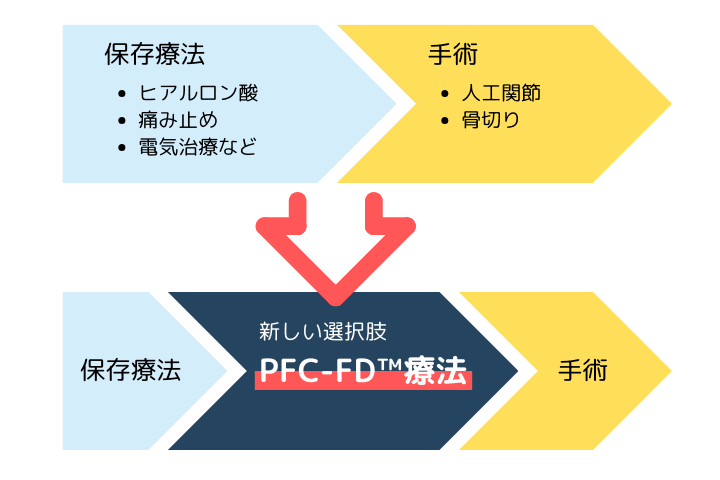PFC-FD™療法は従来の膝治療の新しい選択肢
