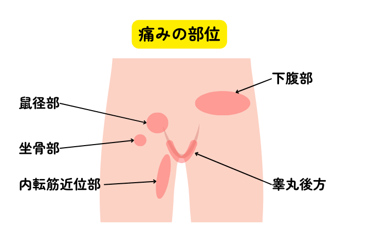 鼠径部痛症候群（グロインペイン症候群）の原因・症状と治療｜スポーツ障害の専門治療｜枚方大橋つじもと整形外科クリニック