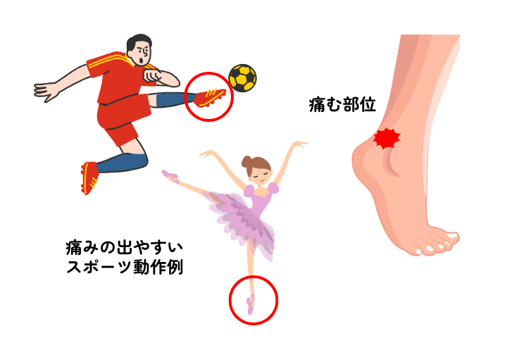足関節後方インピンジメント｜原因・症状・治療・リハビリ・スポーツ